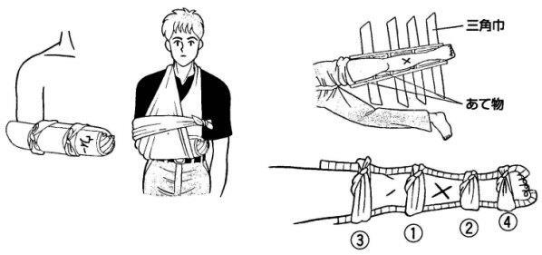 イラスト：骨折時応急手当の固定箇所1、2、3、4　三角巾　あて物